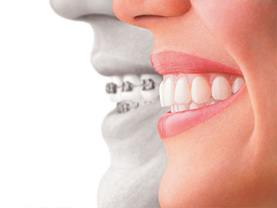 Gaithersburg Complete Dental Care, LLC | All-on-4 reg , Dentures and ZOOM  Whitening