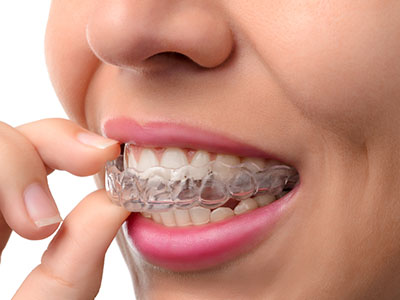 Gaithersburg Complete Dental Care, LLC | Night Guards, Fluoride Treatment and Invisalign reg 