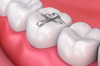 Gaithersburg Complete Dental Care, LLC | Fluoride Treatment, Botox reg  and Extractions