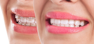 Gaithersburg Complete Dental Care, LLC | Fluoride Treatment, TMJ Disorders and Invisalign reg 