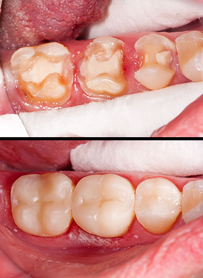 Gaithersburg Complete Dental Care, LLC | Juvederm reg , Crowns and Veneers