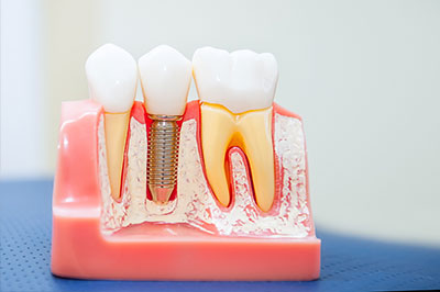 Gaithersburg Complete Dental Care, LLC | Sports Mouthguards, Cosmetic Dentistry and Implant Dentistry