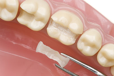 Gaithersburg Complete Dental Care, LLC | Periodontal Treatment, Sports Mouthguards and Oral Exams