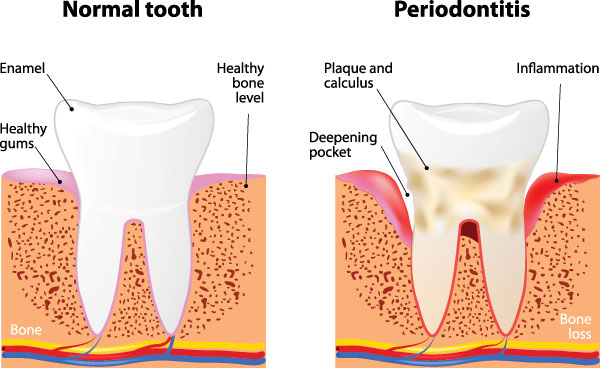 Gaithersburg Complete Dental Care, LLC | Dental Bridges, All-on-6 reg  and Dermal Fillers