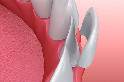 Gaithersburg Complete Dental Care, LLC | ZOOM  Whitening, Dental Sealants and Implant Restorations