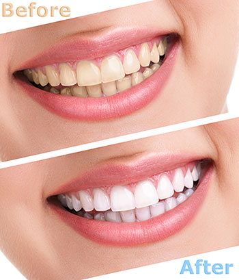 Gaithersburg Complete Dental Care, LLC | Crowns, Botox reg  and Implant Dentistry