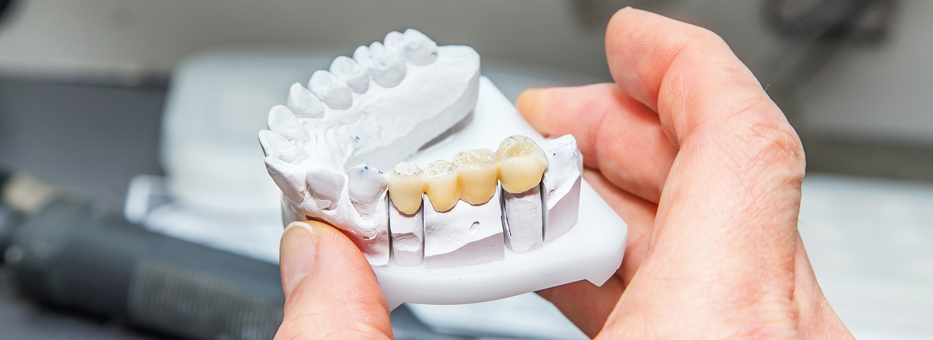 Gaithersburg Complete Dental Care, LLC | Dental Sealants, All-on-4 reg  and Periodontal Treatment